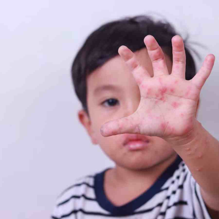 What is Butterfly skin disease, what are the symptoms