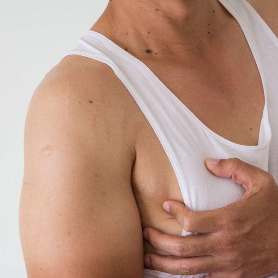 পুরুষের বুকের ছাতিতে অতিরিক্ত মেদ জমতে পারে ইস্ট্রোজেন বাড়লে। 