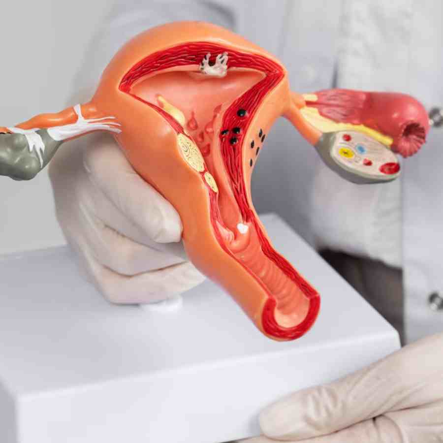 Why Vitamin D deficiency cause Fibroids in women