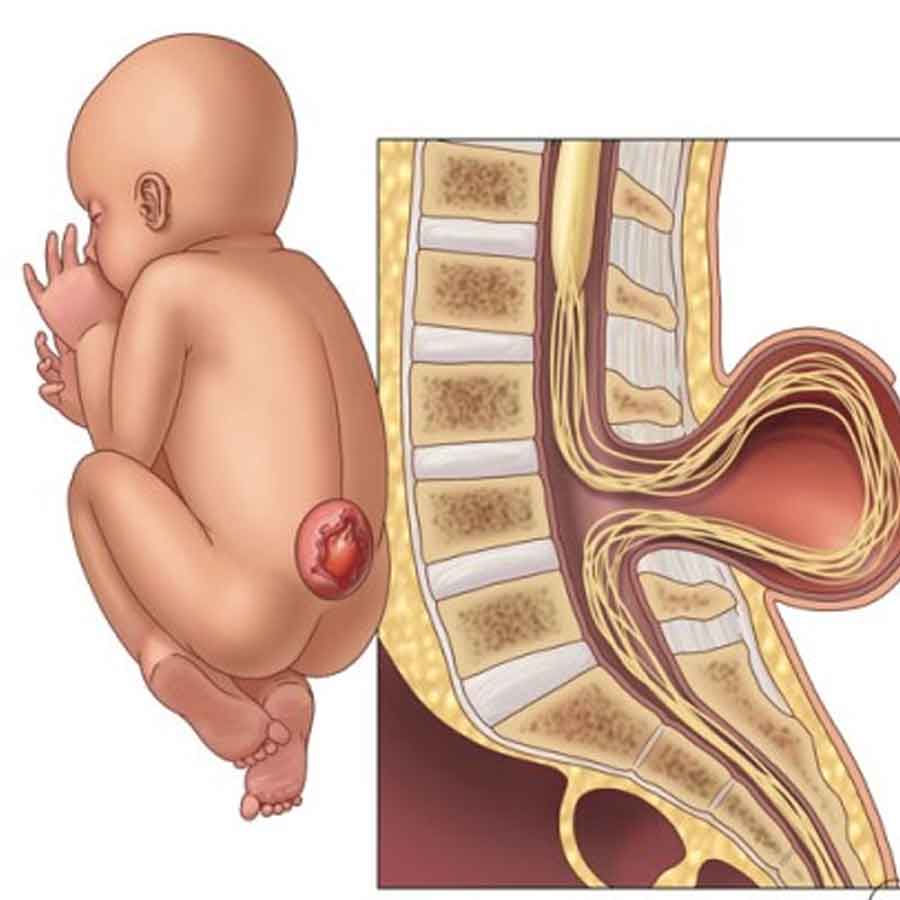 What is the cause of rare disease Spina Bifida, how to prevent this disease