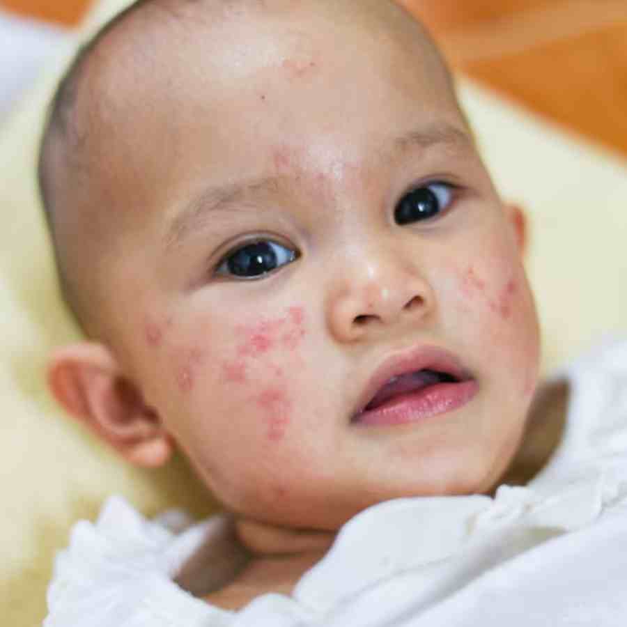 What causes Scabies in Children, how to prevent this type of skin disease
