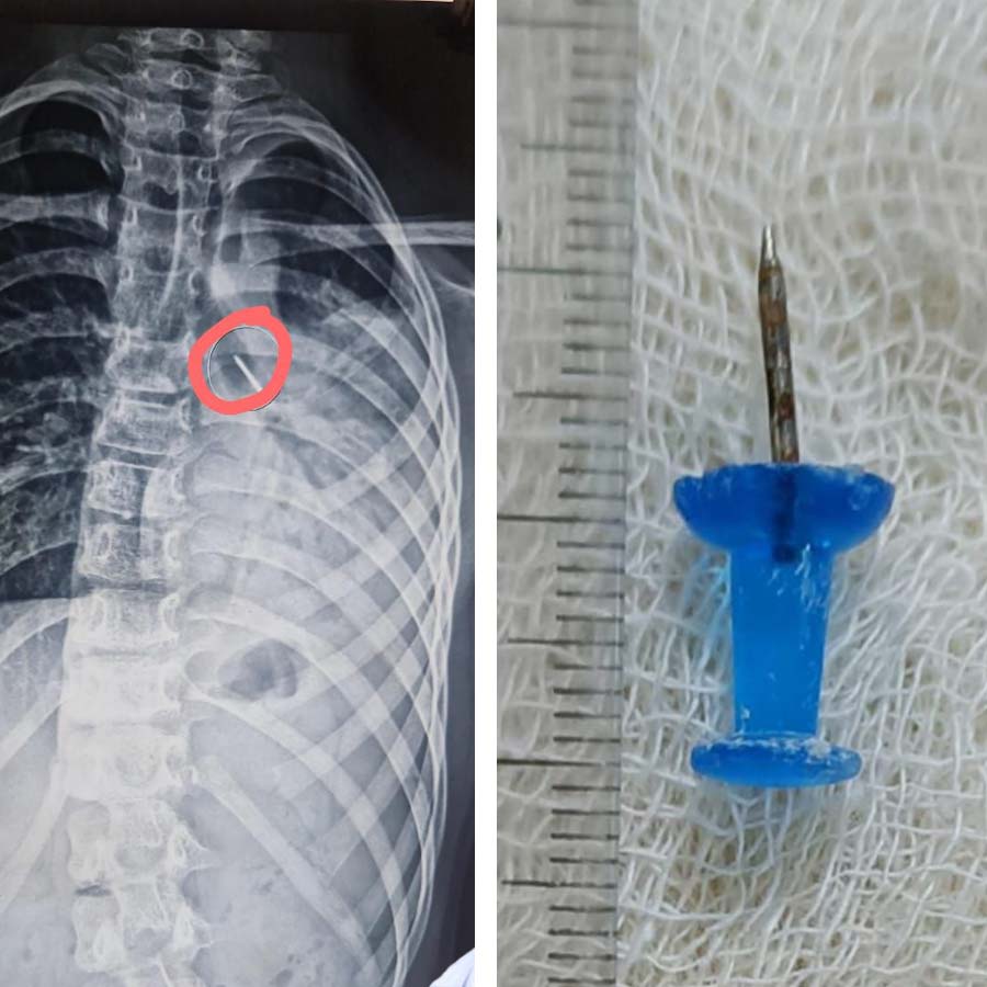 Doctors remove pin from trachea of a 12 years old boy in Calcutta Medical college dgtl