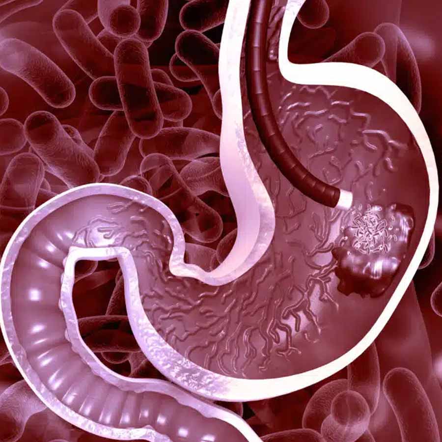 These common symptoms for stomach cancer usually ignored dgtl