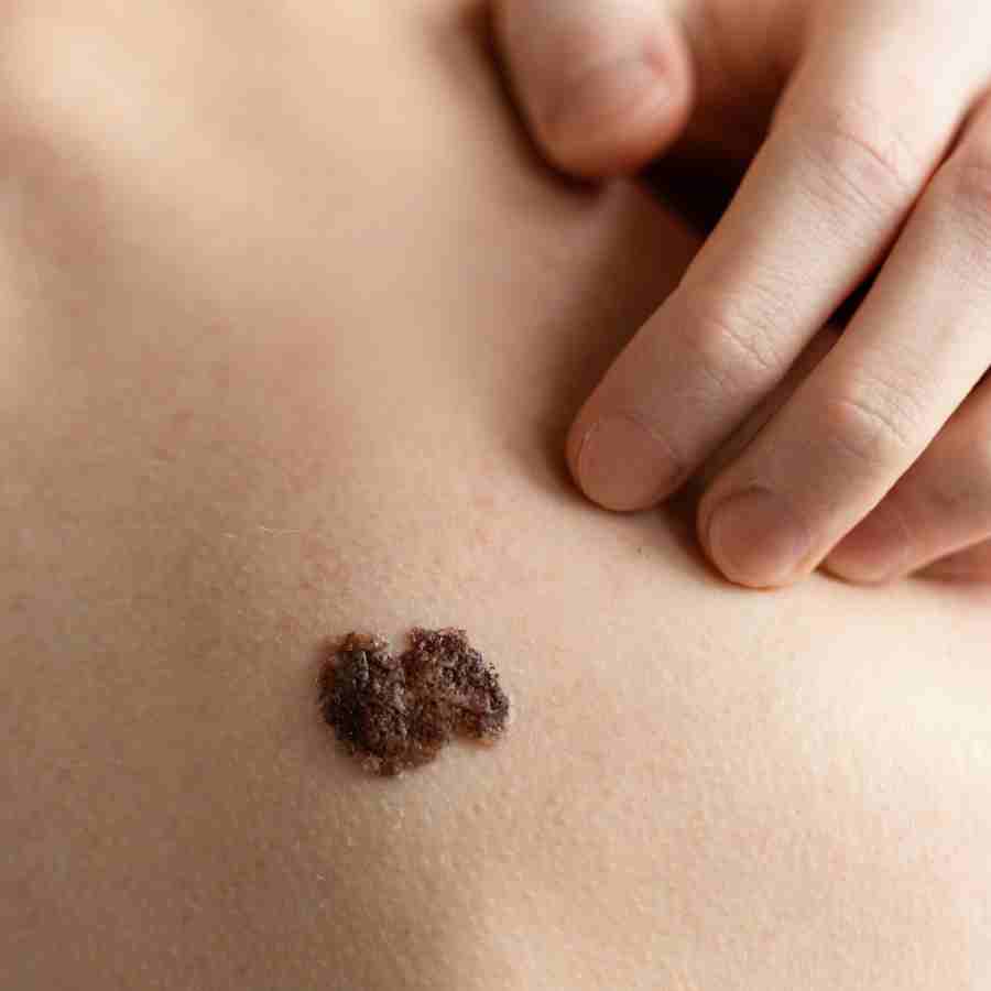 A mole may be a sign of skin cancer if it has irregular borders or an asymmetrical shape