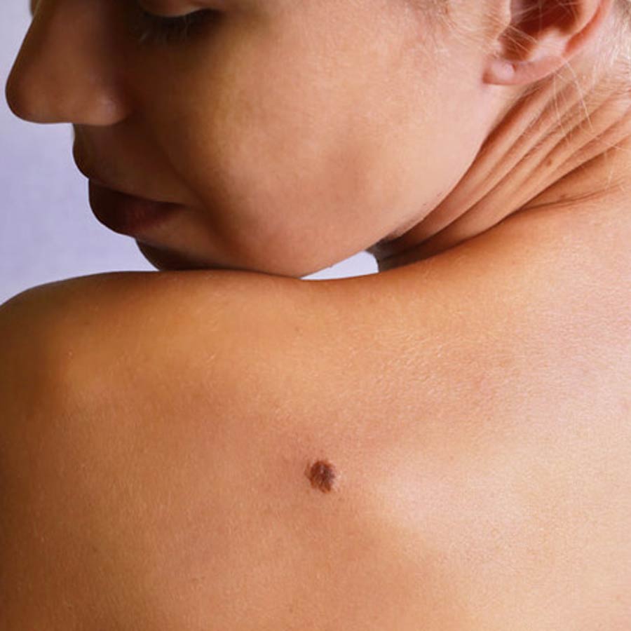 Birthmarks in many parts of our body and their hidden meaning