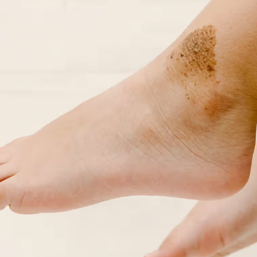 Birthmarks in many parts of our body and their hidden meaning