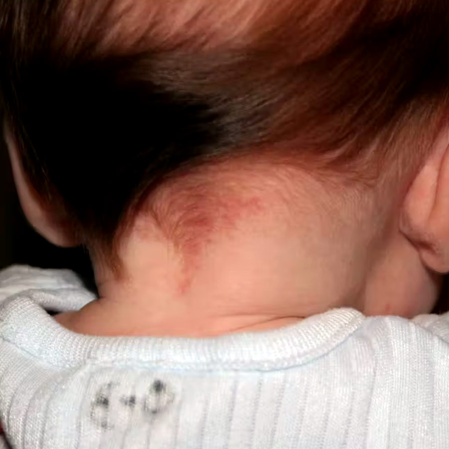Birthmarks in many parts of our body and their hidden meaning