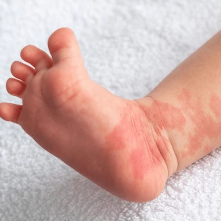 Birthmarks in many parts of our body and their hidden meaning