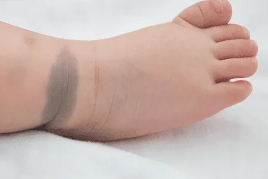 Birthmarks in many parts of our body and their hidden meaning