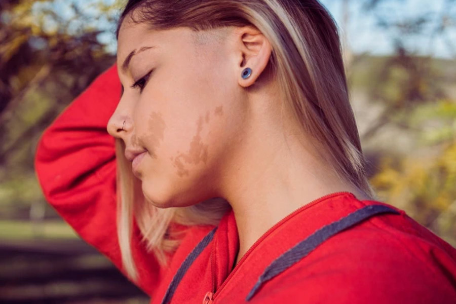 Birthmarks in many parts of our body and their hidden meaning