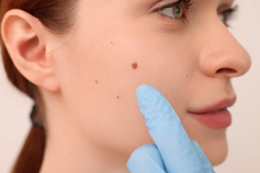 Birthmarks in many parts of our body and their hidden meaning