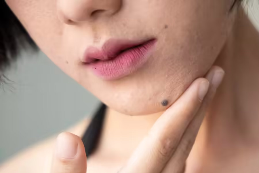 Birthmarks in many parts of our body and their hidden meaning