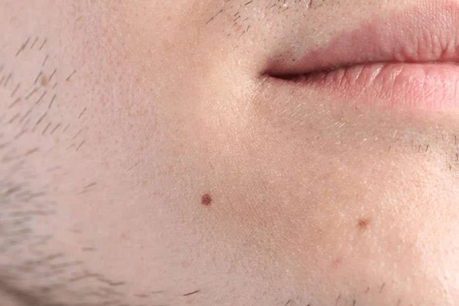 Birthmarks in many parts of our body and their hidden meaning