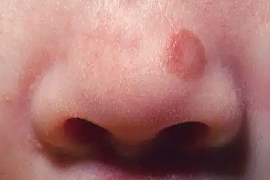 Birthmarks in many parts of our body and their hidden meaning