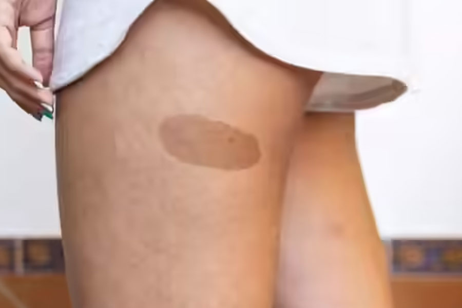 Birthmarks in many parts of our body and their hidden meaning