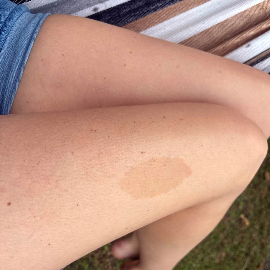 Birthmarks in many parts of our body and their hidden meaning