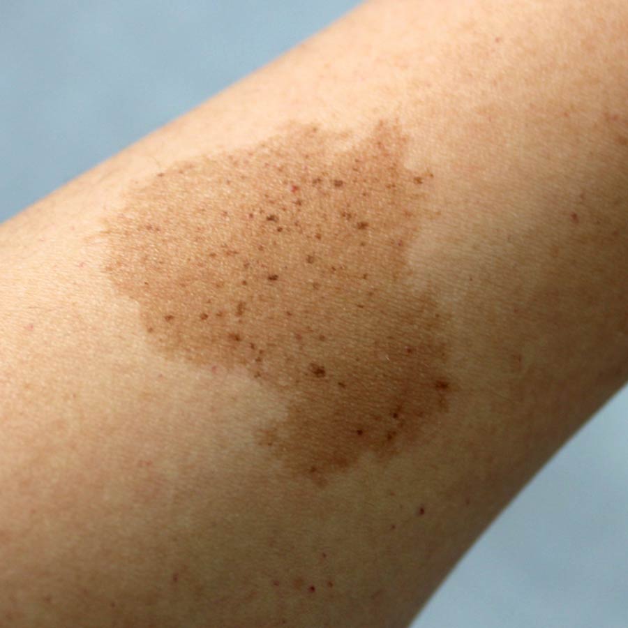 Birthmarks in many parts of our body and their hidden meaning