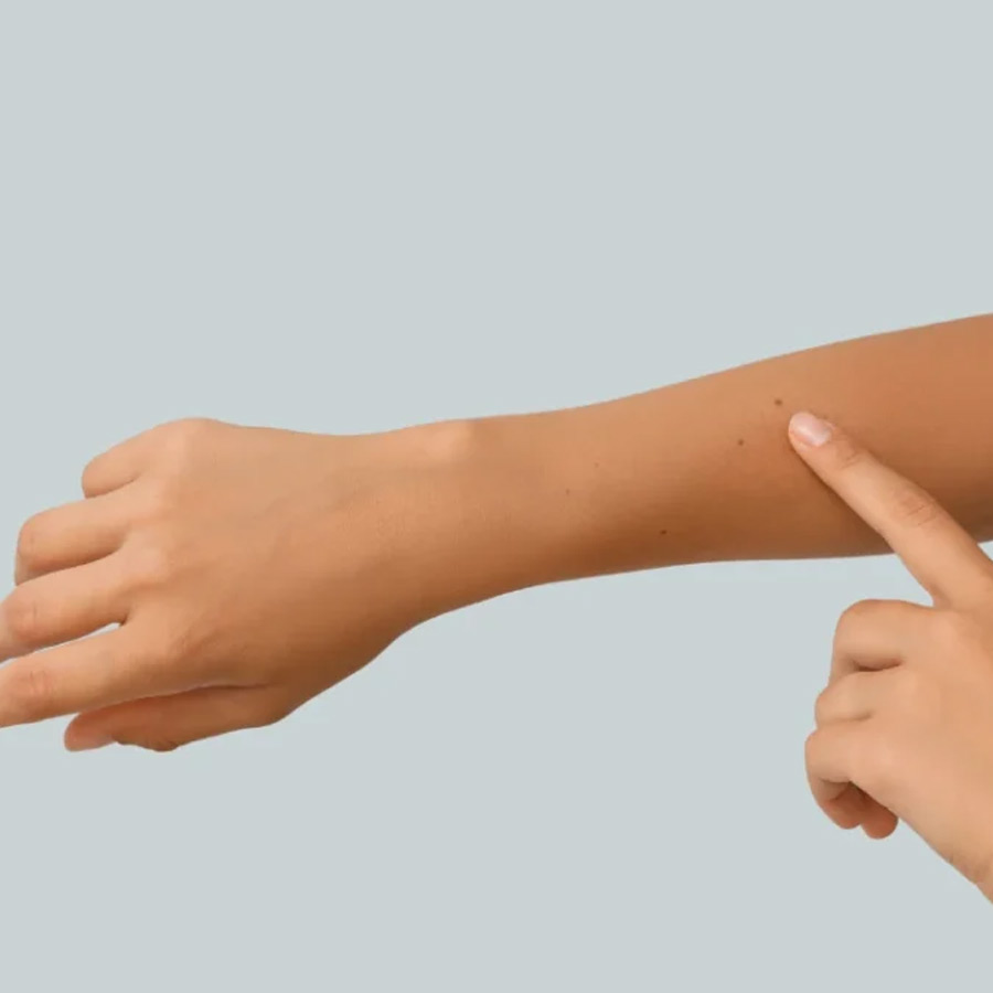 Birthmarks in many parts of our body and their hidden meaning