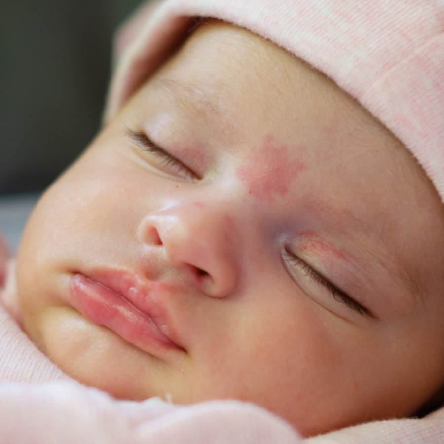 Birthmarks in many parts of our body and their hidden meaning