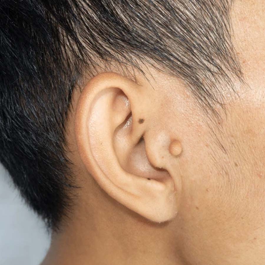 Birthmarks in many parts of our body and their hidden meaning