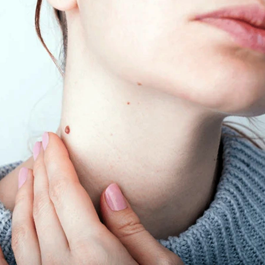 Birthmarks in many parts of our body and their hidden meaning