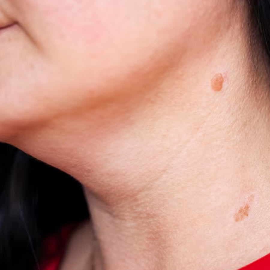 Birthmarks in many parts of our body and their hidden meaning