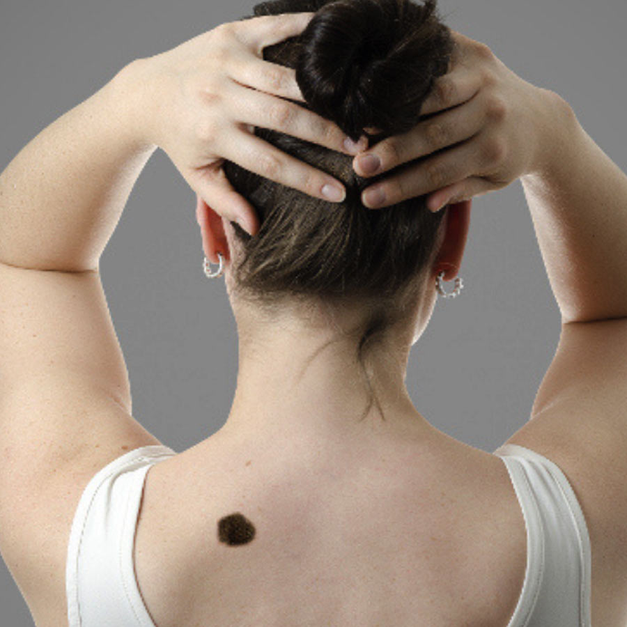 Birthmarks in many parts of our body and their hidden meaning