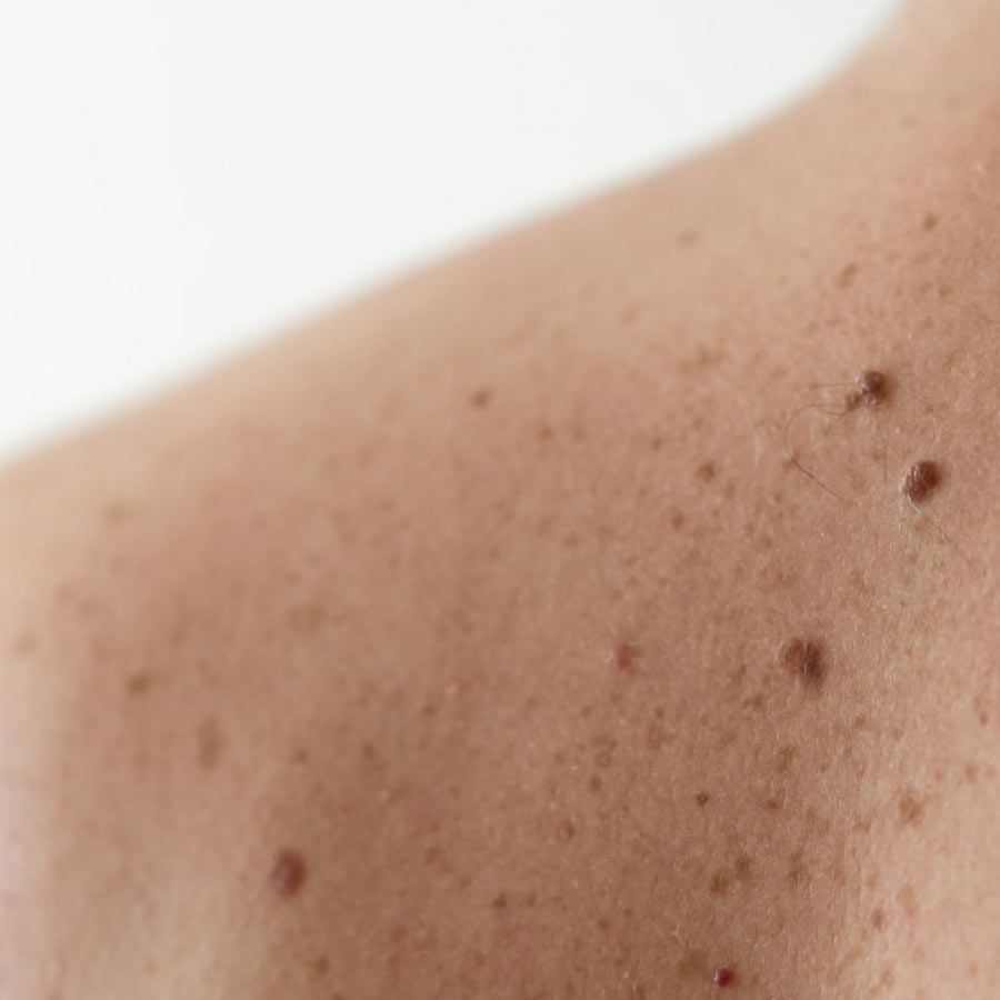 Birthmarks in many parts of our body and their hidden meaning