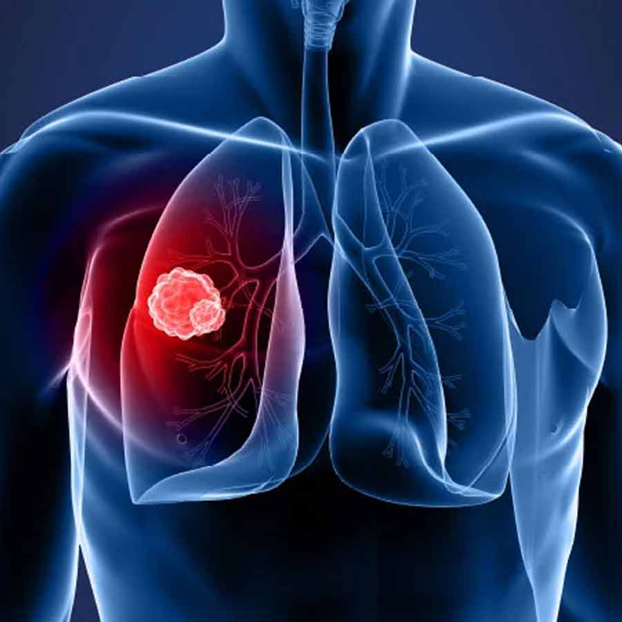 Recent Study says, Lung cancer and pneumonia often mimic each other in the early stages, how to tell the difference
