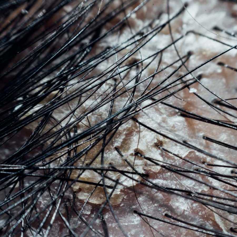 how to treat flaky scalp problem with home remedy dgtl