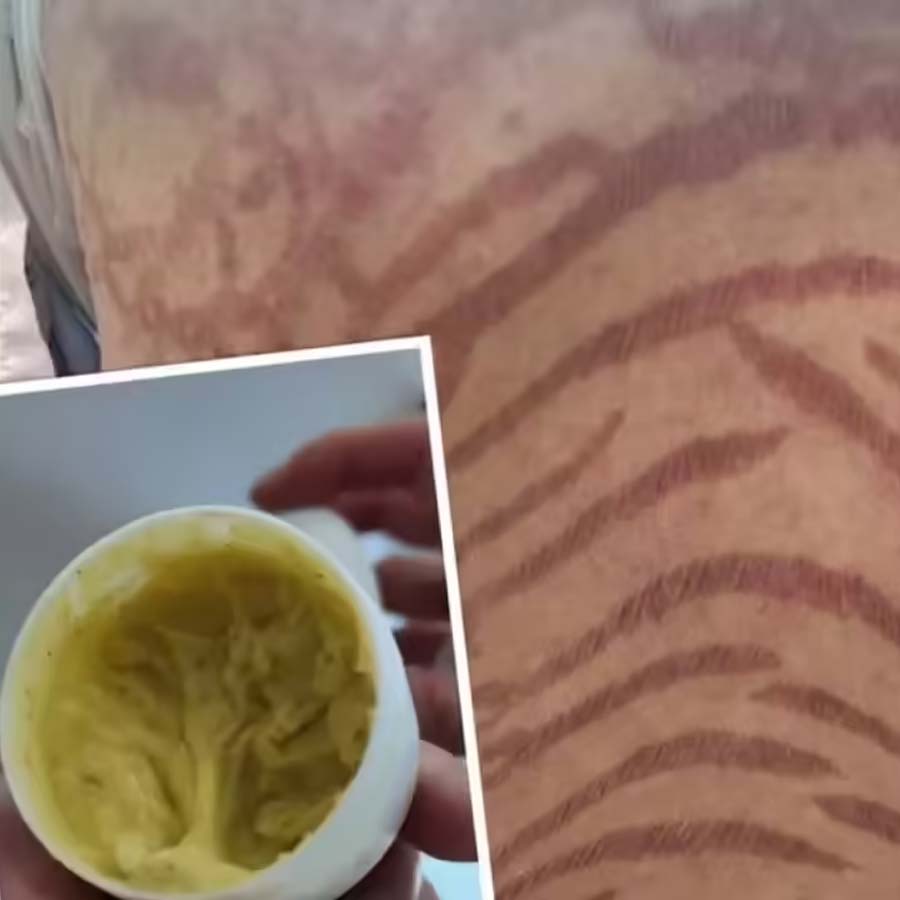 A woman developed severe purplish-red, snake-like marks across her body