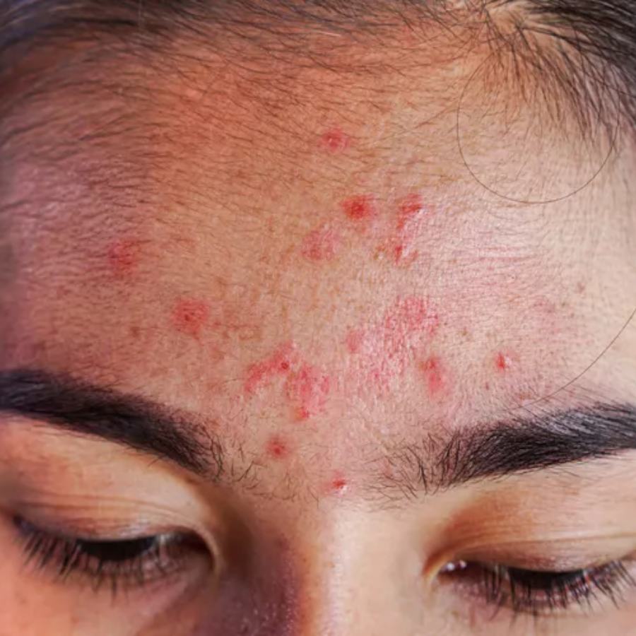 কপালে ব্রণ হওয়ার নেপথ্য কারণ কী?