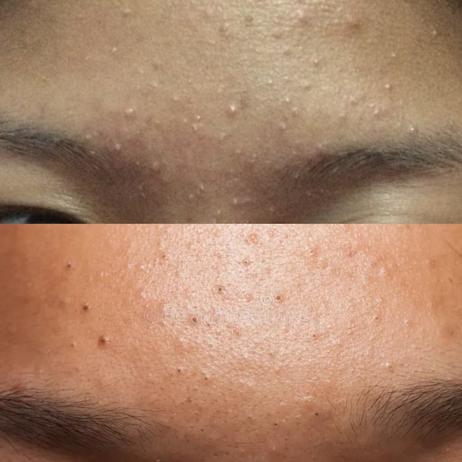 ব্রণ মানেই কেবল লাল রঙের ফোঁড়া নয়, হোয়াইহেড্‌স, ব্ল্যাকহেড্‌সও তৈরি হতে পারে কপালে।