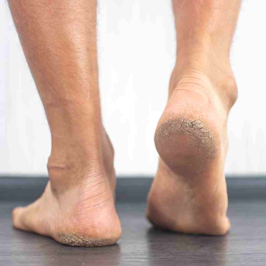 Four health reasons that might cause crack heels dgtl
