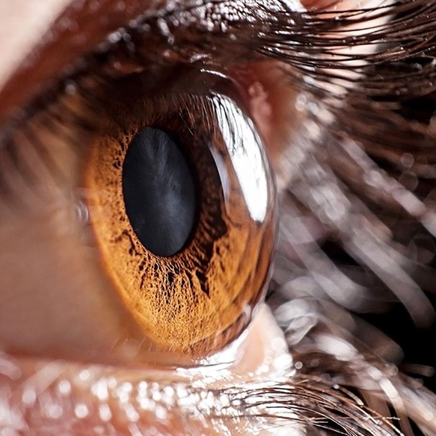 কর্নিয়ার আকৃতি পাল্টে যাওয়ার ঝুঁকি থাকে।