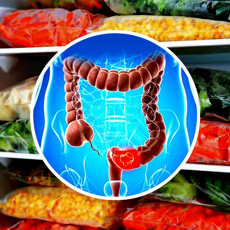 These ready to eat ultra-processed foods could raise the risk of Colon Cancer