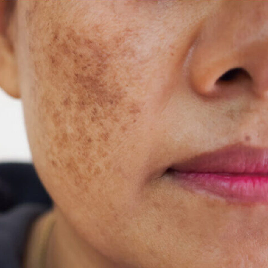 How to get rid of melisma with 5 home remedies dgtl