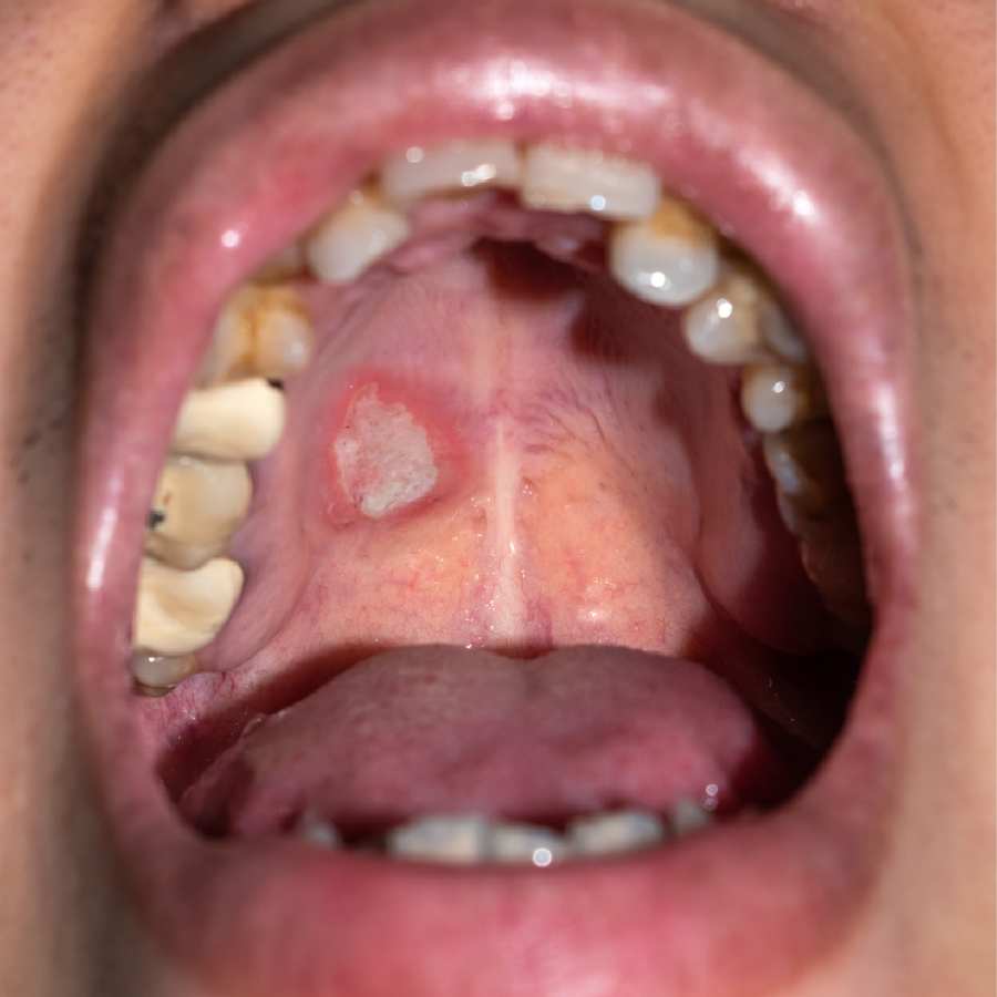 মুখের ক্যানসারের ঝুঁকি কী ভাবে কমাবেন?