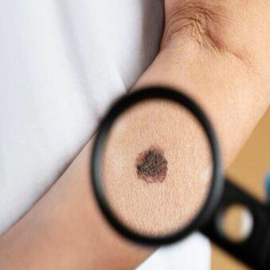 Three sings to look when moles become dangerous