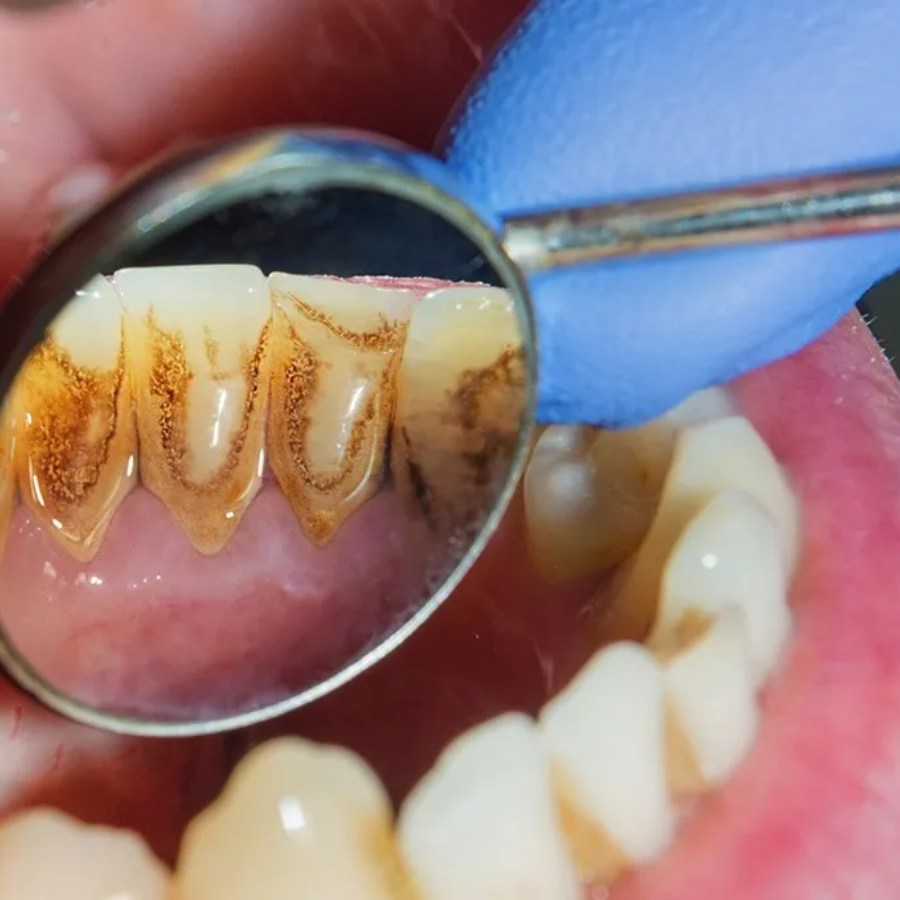How to remove tartar from teeth with simple home remedies dgtl