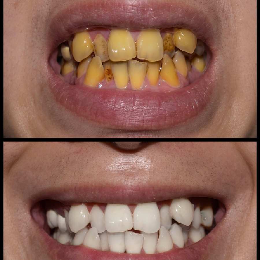 ১০ টাকারও কম খরচে কী ভাবে দাঁতের হলদে ছোপ দূর হবে?