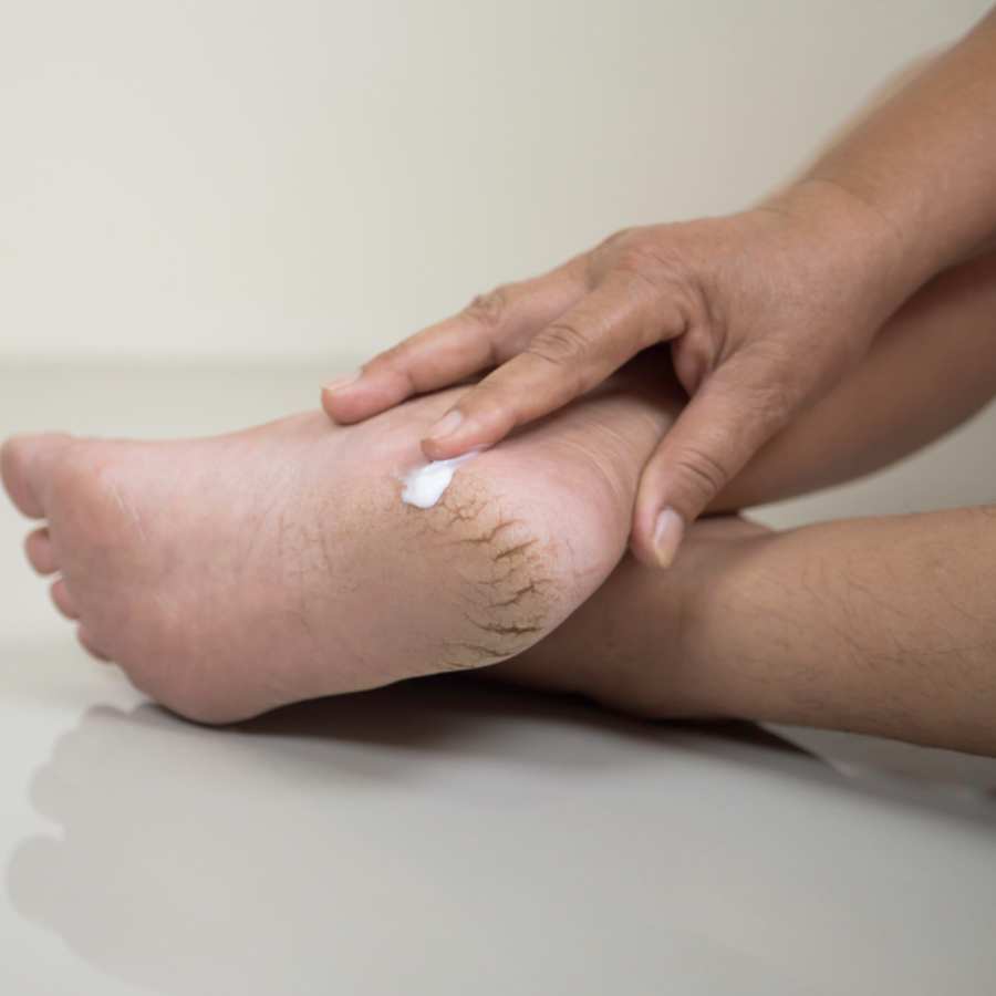 Home remedies for crack heel problem dgtl