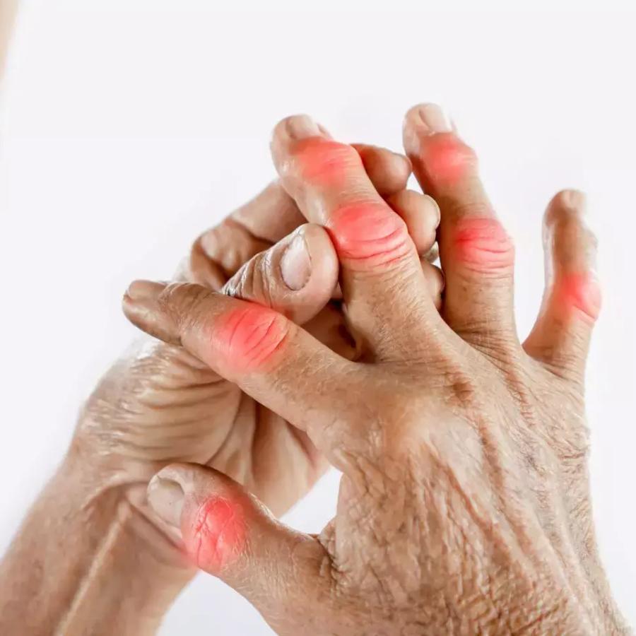 through lifestyle changes you can bring down uric acid in seven days, here is how dgtl