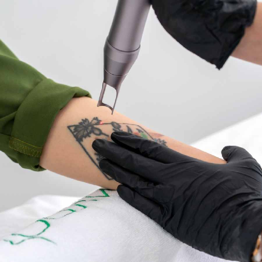 Things you should keep in mind while tattoo removal dgtl