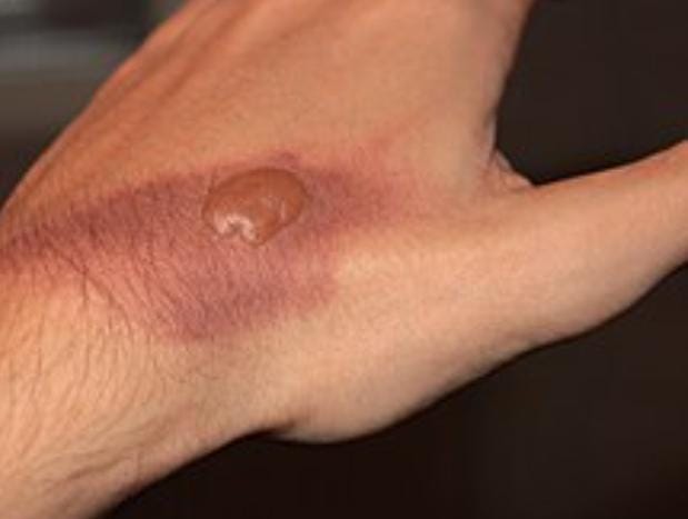  যদি হাতে ফোস্কা পড়ে, তা হলে সেটিকে ফাটিয়ে দেবেন না কোনও ভাবেই। এটি ক্ষত স্থানের উপরে একটি আস্তরণের কাজ করে। এটিকে ফাটিয়ে দিলে আরও ক্ষতি। 