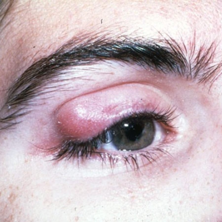 Lump in eyelids can be caused due to makeup if it stays for long dgtl