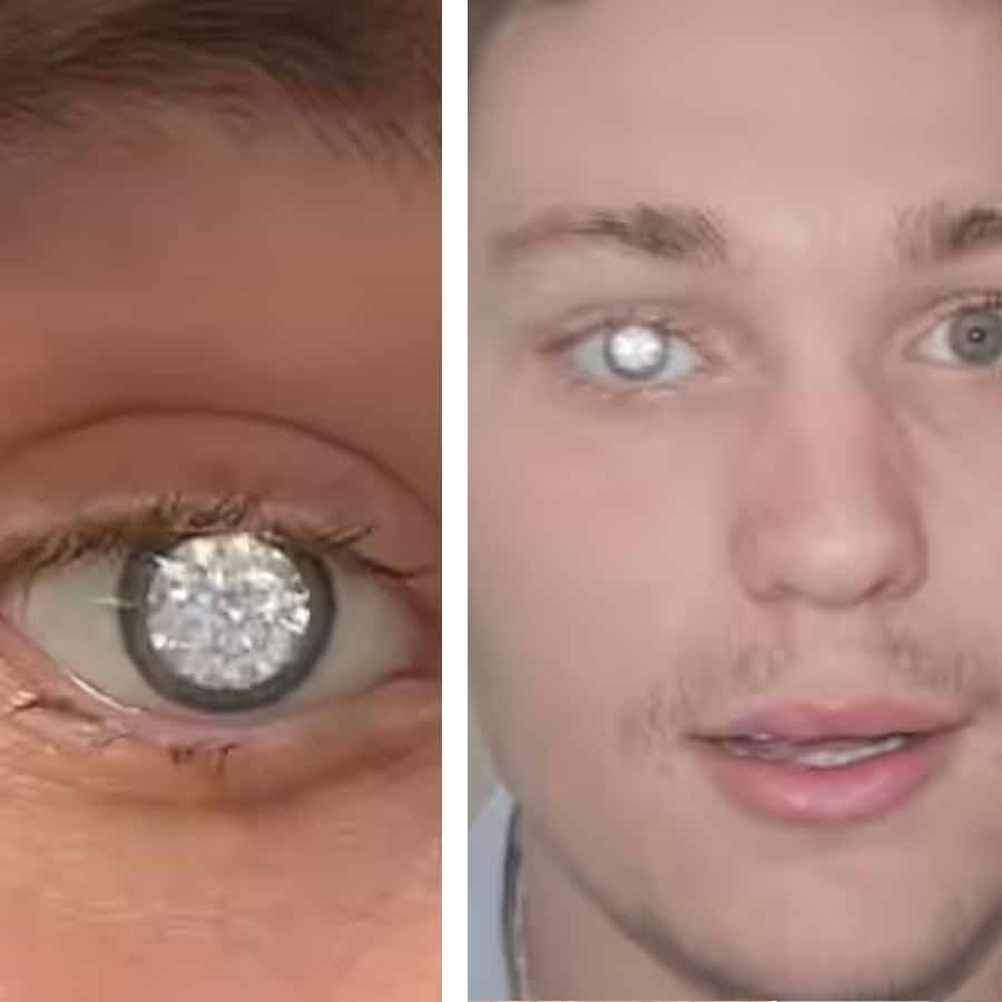 man had a two-carat diamond fitted into his custom prosthetic eye