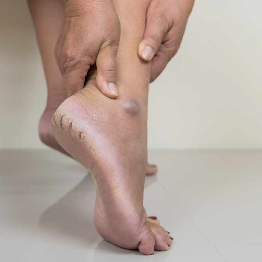 ফাটা গোড়ালির সমস্যা রুখে দিন শীত আসার আগেই।