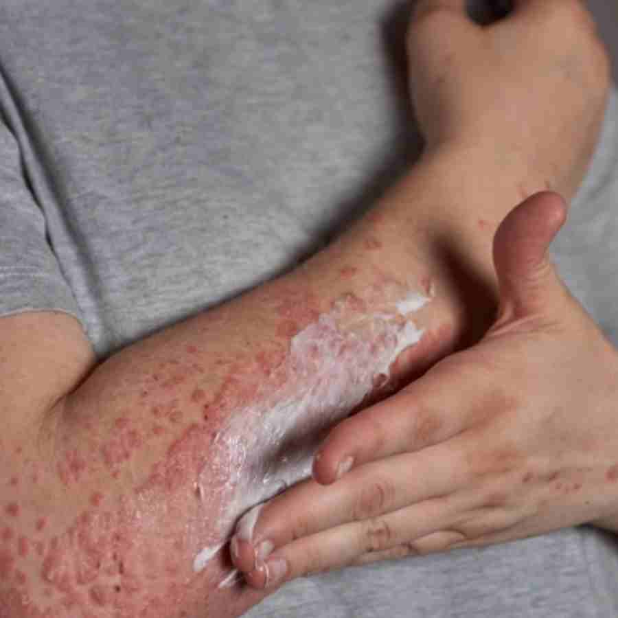 Chickenpox outbreak in Kerala, what are symptoms and prevention tips