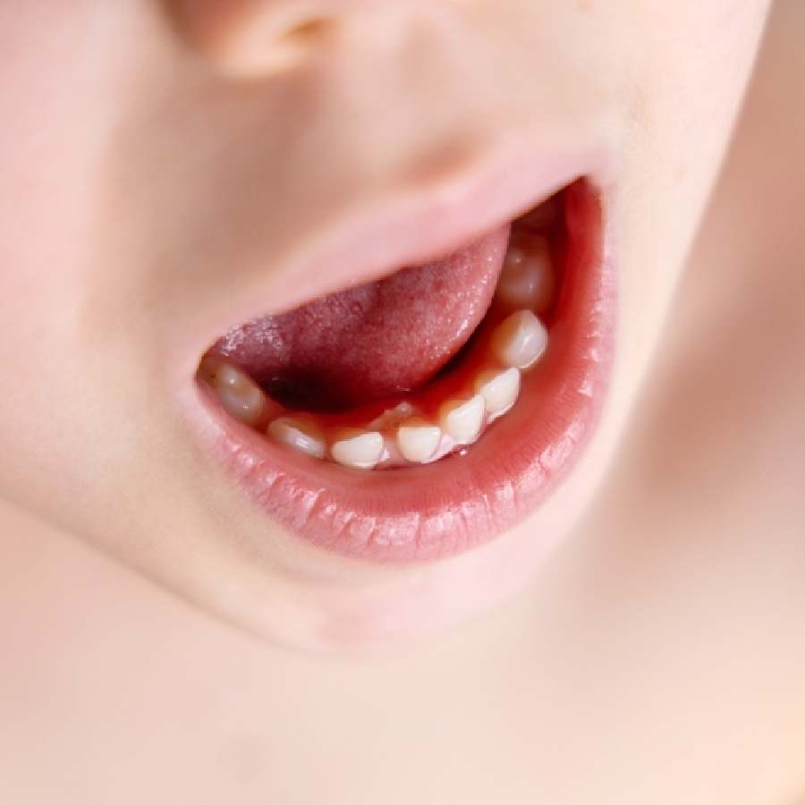 11-year-old girl has 81 Teeth,  a rare condition seen in only 3% of People dgtl